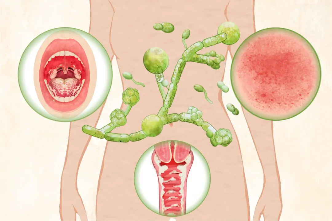 The most common type of yeast infection is the vaginal yeast infection, which affects 75 percent of women in their lifetime. (Illustration by The Epoch Times, Shutterstock)