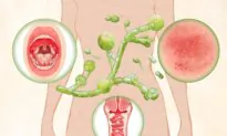 Yeast Infection: Symptoms, Causes, Treatments, and Natural Approaches