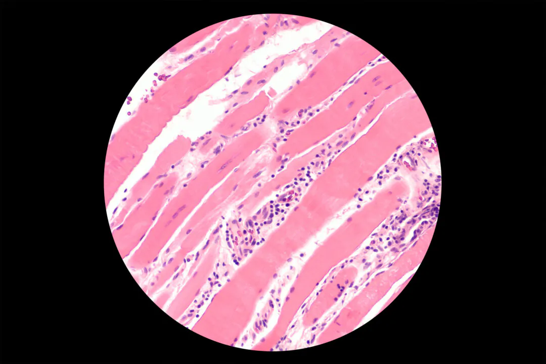 Pathology of a muscle autoimmune condition, where immune cells attack the muscles. (David A Litman/Shutterstock)