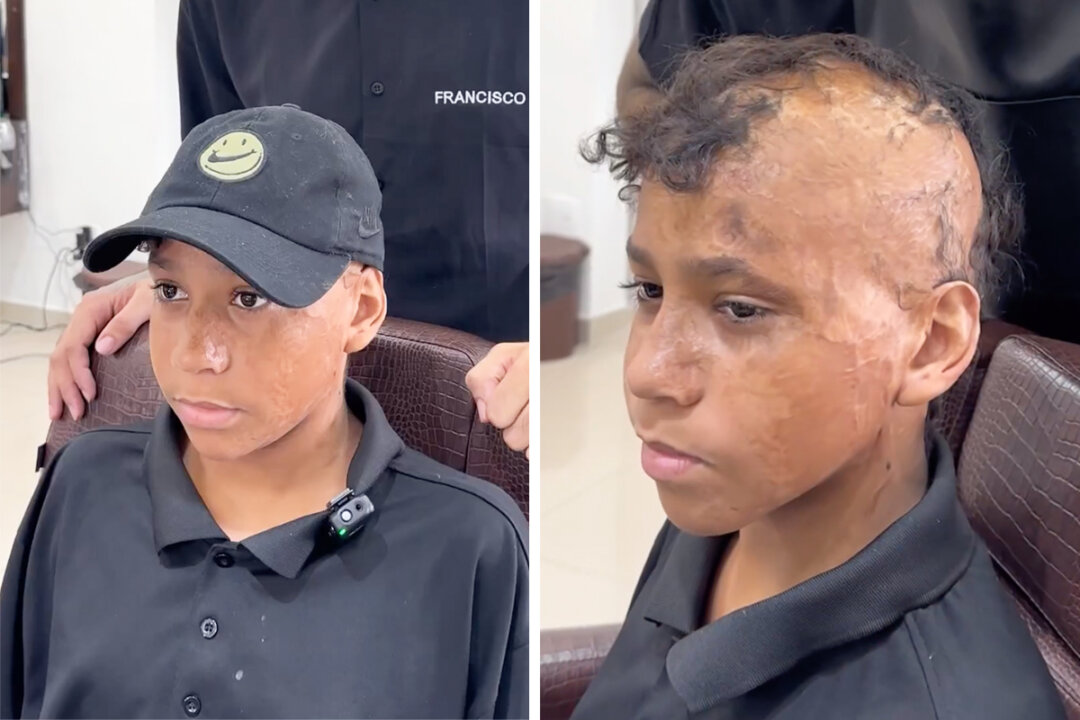 12-Year-Old Burn Victim Gets His 'Hair' Back After a Decade—Watch His Incredible Makeover: VIDEO