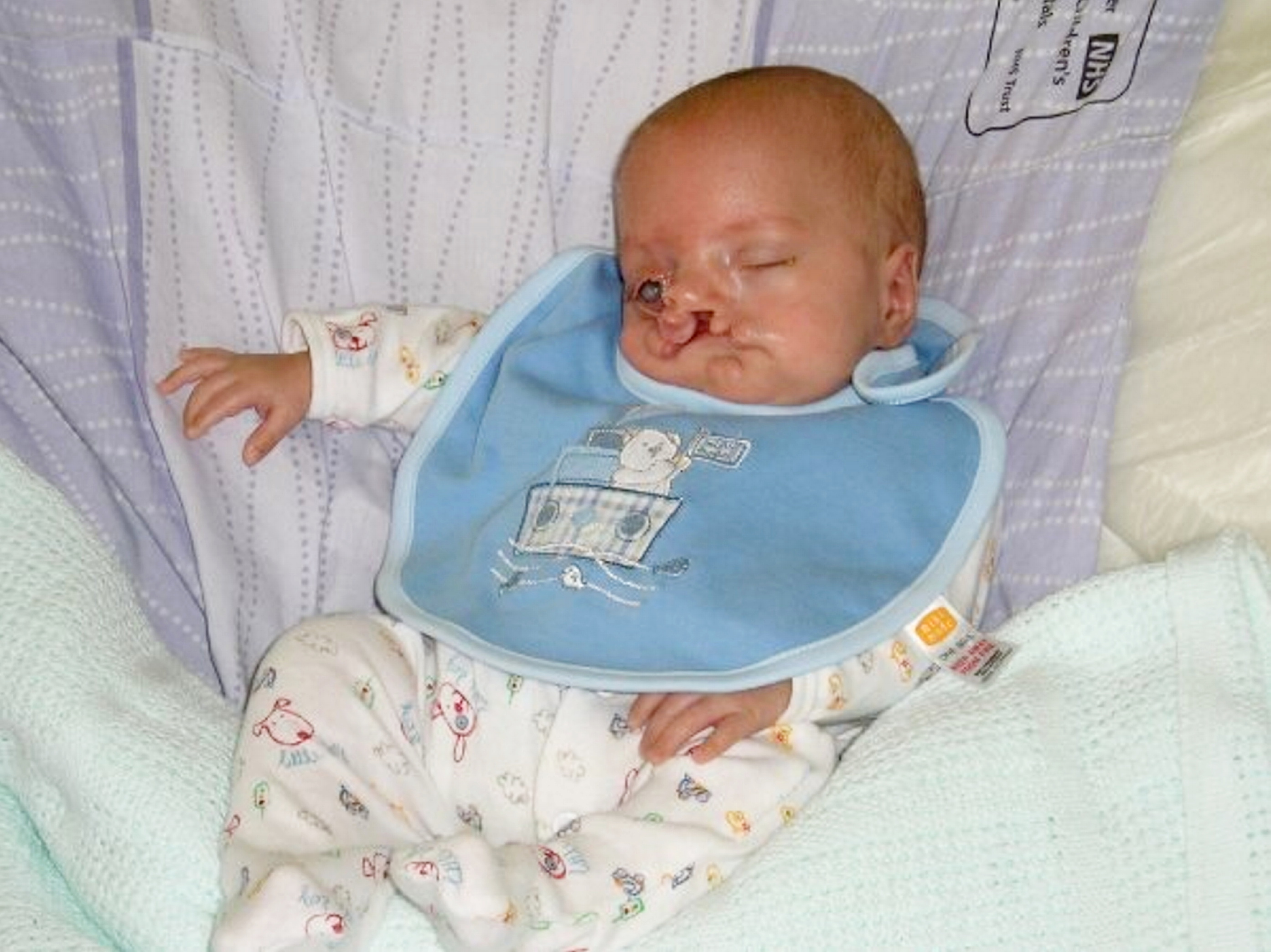 Zac Coates was born with a left lip and palate.