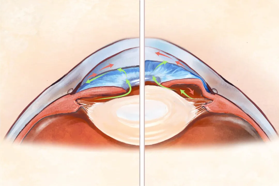 Glaucoma is the second leading cause of blindness next to cataracts. (Illustration by The Epoch Times)