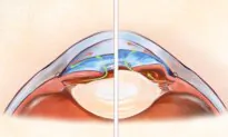 Glaucoma: 2nd Leading Cause of Blindness—Here Are the Main Signs