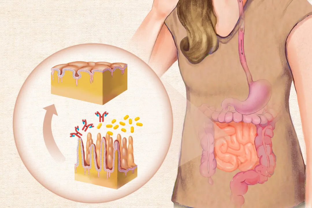 Celiac disease occurs in people who are genetically predisposed to be intolerant to gluten. (Illustration by The Epoch Times, Shutterstock)