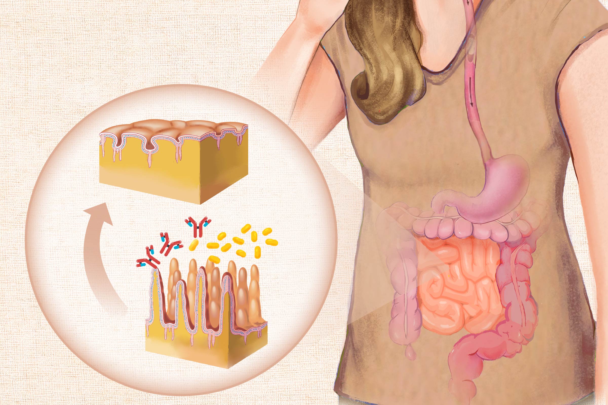 Celiac Disease: Symptoms, Causes, Treatments, and Natural Approaches