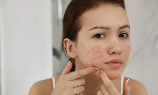 Rosacea Linked to Skin Cancer, Including Malignant Melanoma