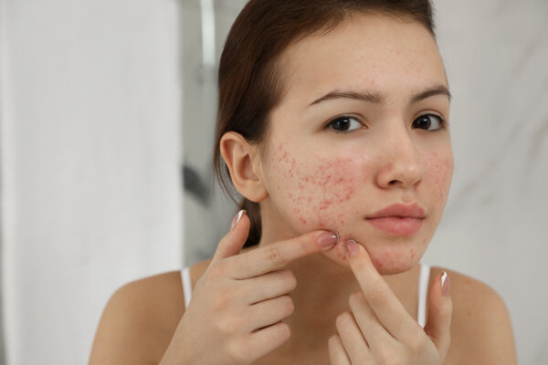 Rosacea Linked to Skin Cancer, Including Malignant Melanoma