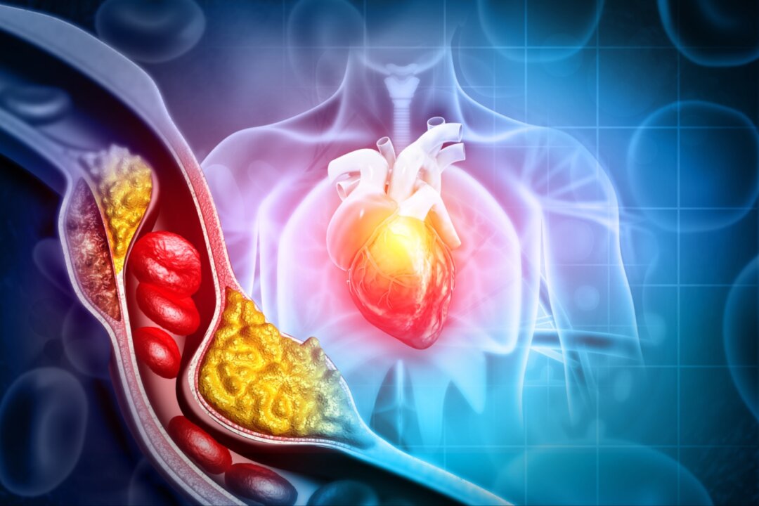 Do You Need Medication for High Cholesterol? Beware of Statin Side Effects
