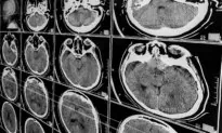 People Near Death From Traumatic Brain Injury May Still Revive: Study