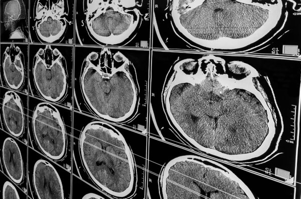 People Near Death From Traumatic Brain Injury May Still Revive: Study