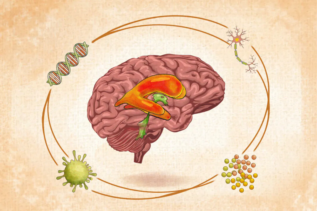 Although the cause of schizophrenia is unknown, a combination of genetic, environmental, and physiological factors plays a role. Pictured are enlarged ventricles, observed in 80 percent of people with schizophrenia. (Illustration by The Epoch Times, Shutterstock)