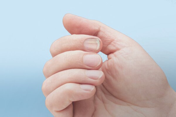 Fingernail Changes May Be Clues About Increased Cancer Risk