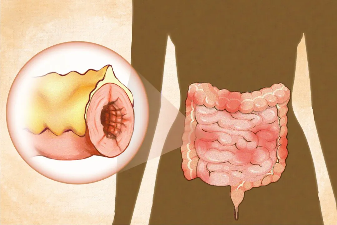 Crohn's disease is an inflammatory bowel disease that involves "creeping fat" wrapping around parts of the intestines and inflammation that can occur anywhere in the gastrointestinal tract. (Illustration by The Epoch Times, Shutterstock)