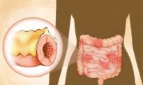 Crohn’s Disease: Symptoms, Causes, Treatments, and Natural Approaches