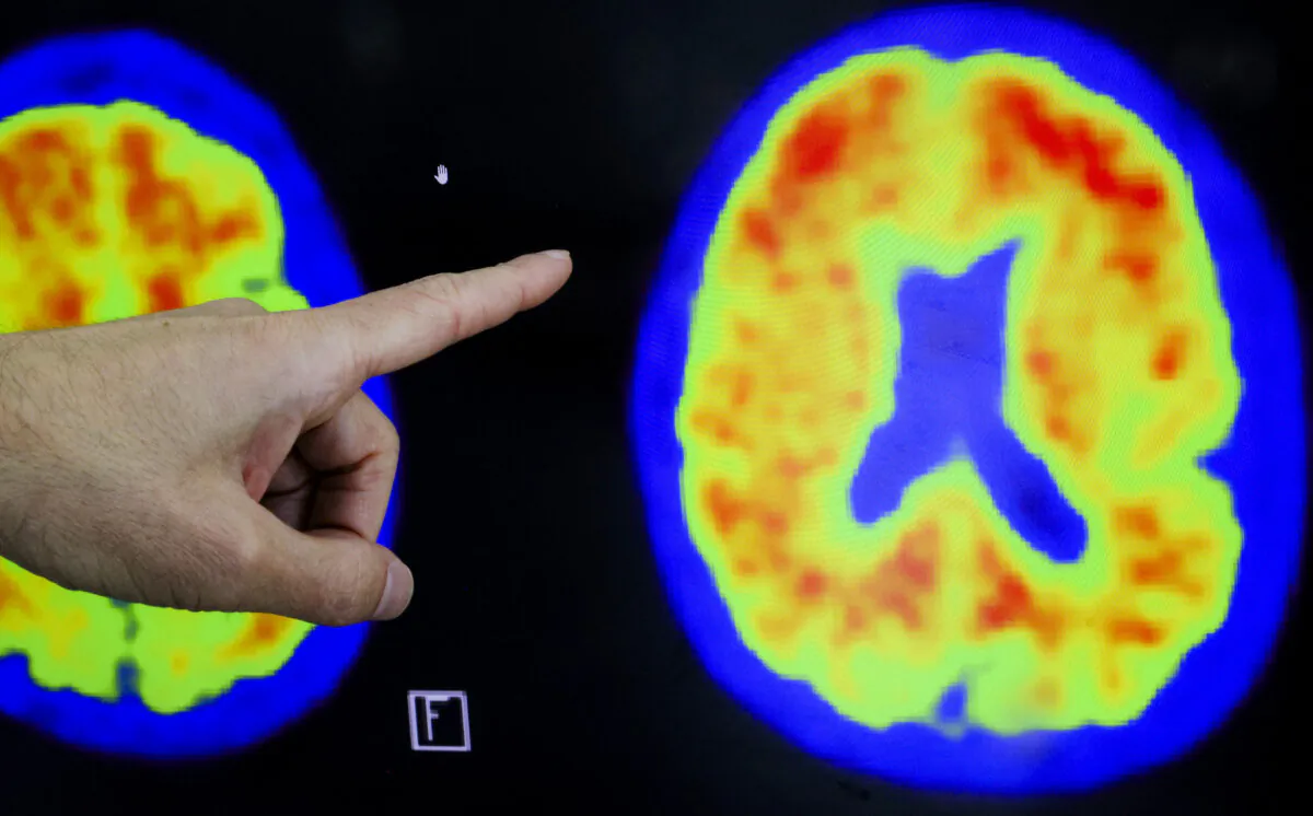 A doctor points to evidence of Alzheimer’s disease on PET scans at the Center for Alzheimer Research and Treatment at Brigham And Women’s Hospital in Boston on March 30, 2023. (Brian Snyder/Reuters)