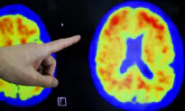 FDA Approves New Alzheimer’s Treatment That May Slow Decline in Memory