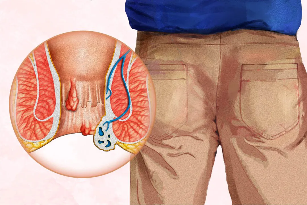 About half of people 50 and older have hemorrhoids, or piles. (Illustration by The Epoch Times, Shutterstock)