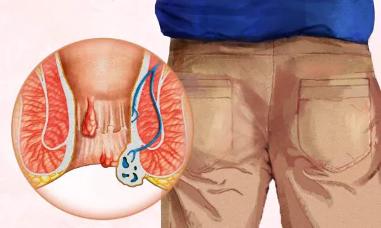 Hemorrhoids: Symptoms, Causes, Treatments, and Natural Approaches