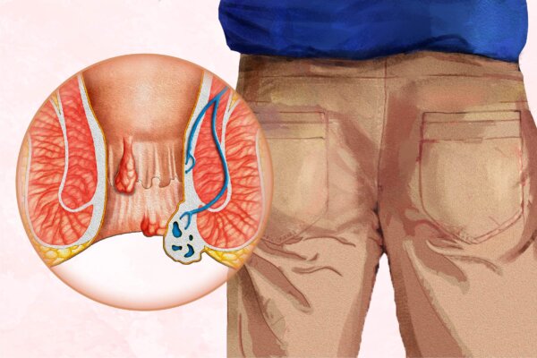 Hemorrhoids: Symptoms, Causes, Treatments, and Natural Approaches