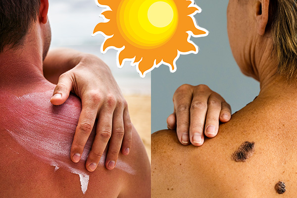 A New Perspective on Sun Exposure: Can Sunlight Actually Prevent Melanoma?