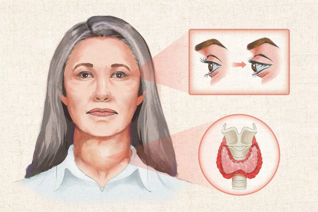 An overactive thyroid can lead to symptoms that include bulging eyes and an enlarged thyroid (goiter). (Illustration by The Epoch Times, Shutterstock)