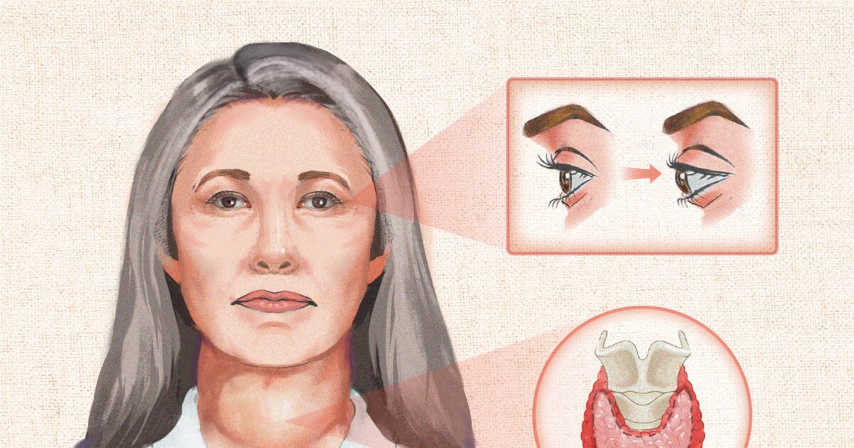 Graves’ Disease: Symptoms, Causes, Treatments, And Natural Approaches