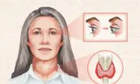 Graves’ Disease: Symptoms, Causes, Treatments, and Natural Approaches