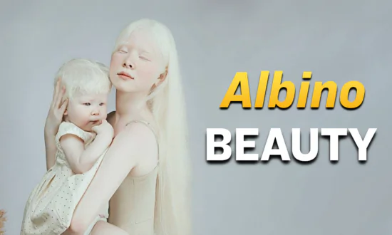 Albino Sisters: A Story of Beauty and Strength
