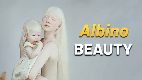 Albino Sisters: A Story of Beauty and Strength