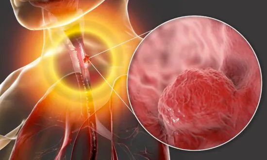 Watch Out for the Early Warning Signs of Esophageal Cancer