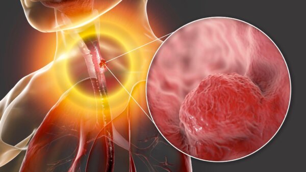 Early Warning Signs of Esophageal Cancer