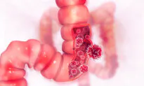 Colorectal Cancer in Young Adults: Diet, Stress, and Emerging Risk Factors