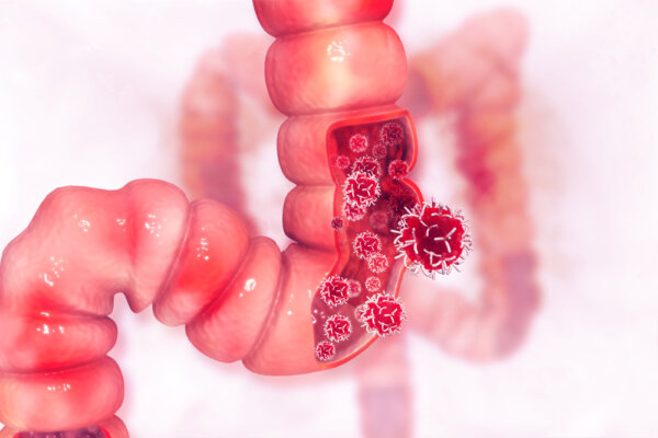 Colorectal Cancer Rates Up to 500 Percent in Children