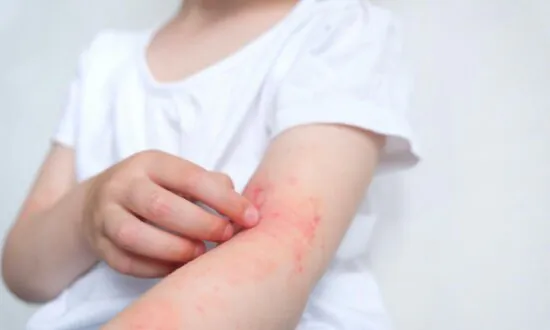 5 Main Causes of Eczema and How to Heal Naturally Through Diet