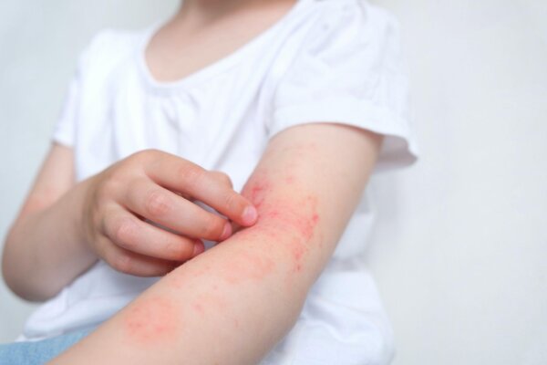 5 Main Causes of Eczema and How to Heal Naturally Through Diet