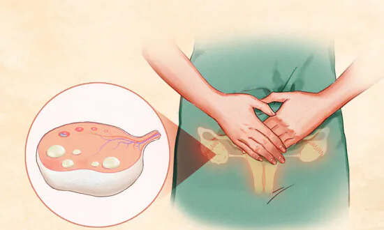 Polycystic Ovary Syndrome: Symptoms, Causes, Treatments, and Natural Approaches