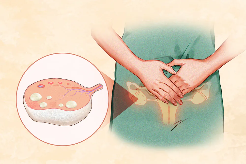 PCOS is the most common hormonal disorder among girls and women in their child-bearing years. (Illustration by Minghui Zhang)