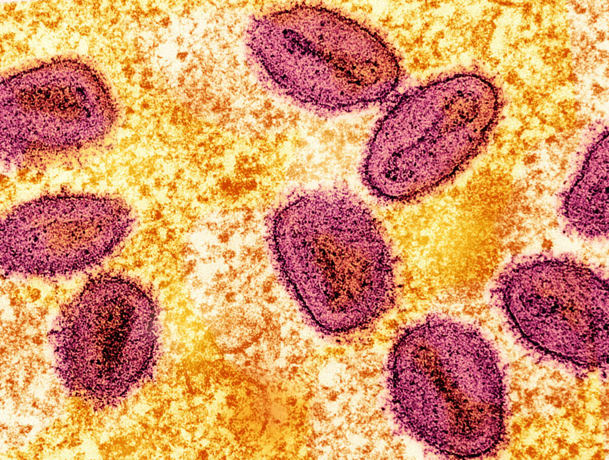 An undated colorized transmission electron micrograph of mpox virus particles (pink) found within an infected cell (yellow), cultured in the laboratory, captured at the National Institute of Allergy and Infectious Diseases (NIAID) Integrated Research Facility (IRF) in Fort Detrick, Md.  (NIAID/Handout via Reuters)