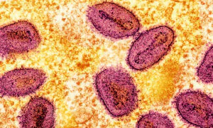 Severe Mpox Virus Strain Possibly Spreading in LA County, Officials Warn