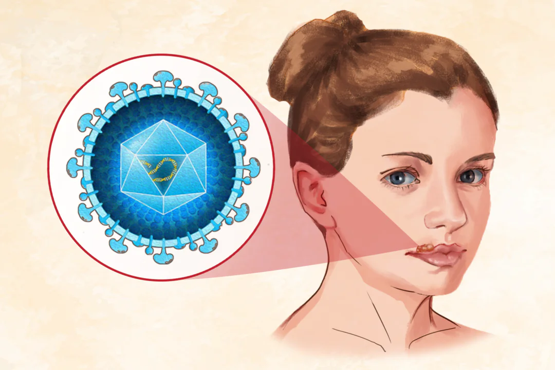 Herpes is a highly contagious infection with 50 to 80 percent of U.S. adults with oral herpes and about one in six people aged 14 to 49 with genital herpes. (Illustration by Fei Meng)