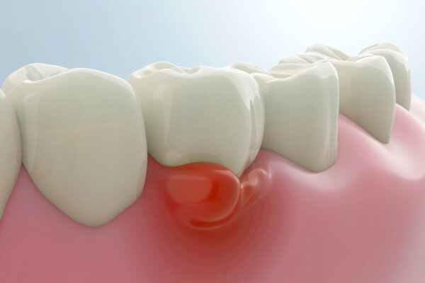 New Antibiotic Fights Severe Gum Disease