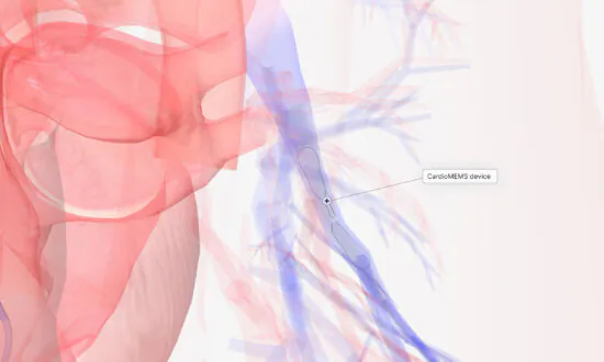 A Paper Clip-Sized Device Is Changing Heart Failure Treatment