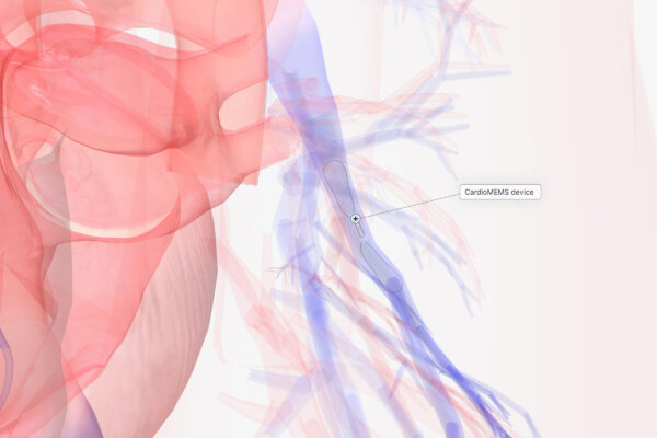 A Paper Clip-Sized Device Is Changing Heart Failure Treatment 