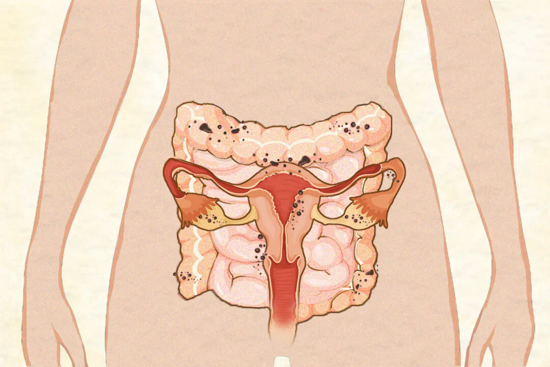 In endometriosis, endometrial-like cells outside the uterus form lesions and adhesions that can spread. (Illustration by The Epoch Times, Shutterstock)