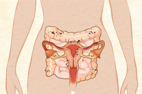 Major Causes of Endometriosis