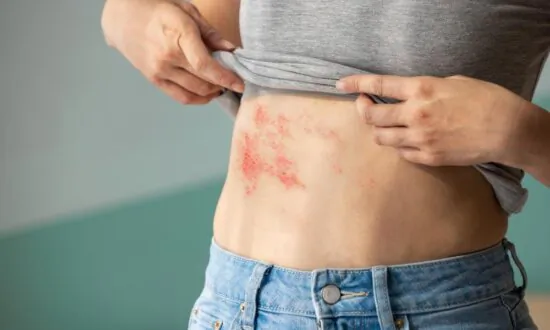 The Early Signs of Shingles and How to Treat the Condition