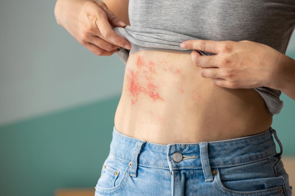 Shingles: Early Signs, Complications, and Treatment Methods