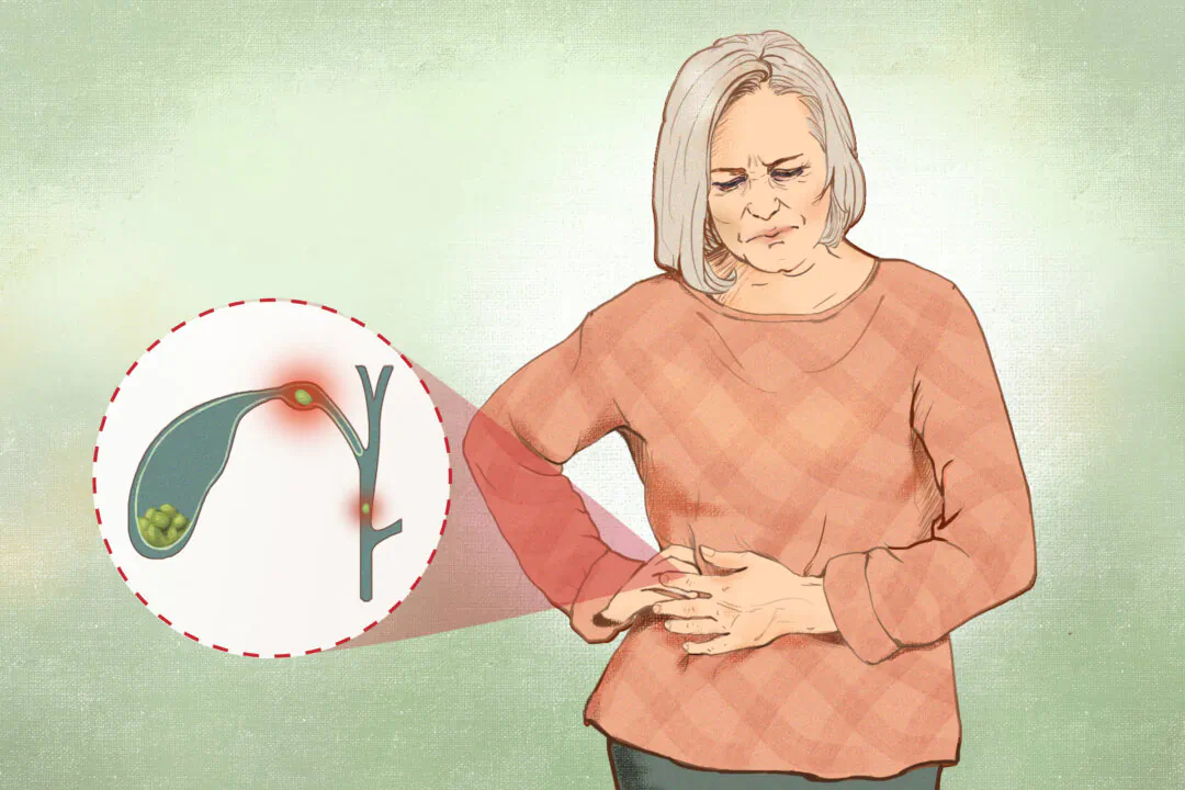 Gallstones cause sudden, severe pain in the upper right abdomen, often with nausea and vomiting. (Illustration by Fei Meng)