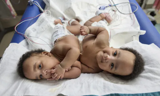 Twins Born Conjoined Celebrate 1st Birthday After Separation Surgery
