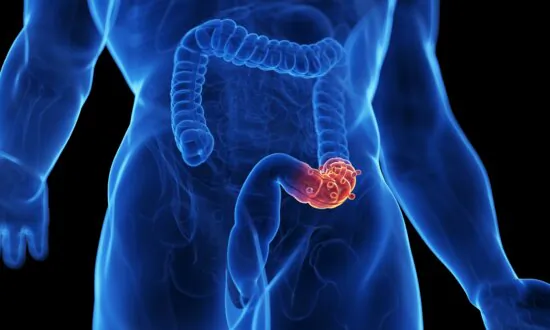Diverticulitis Dilemma: Why Surgery May Not Guarantee Relief